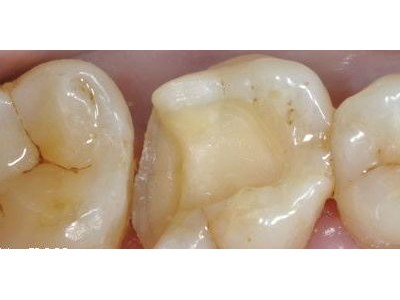 各类牙齿修复-上海市周到的牙齿修复