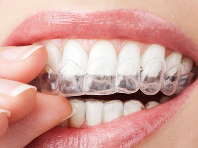 香港义齿加工厂 固定义齿 3D 打印牙科矫正器出口